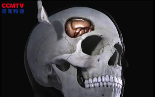 颅咽管瘤（右侧翼点入路 - 3D模拟）